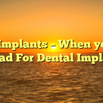 Oral Implants – When you Go Abroad For Dental Implants?