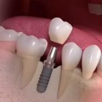 Dental Implants Abroad