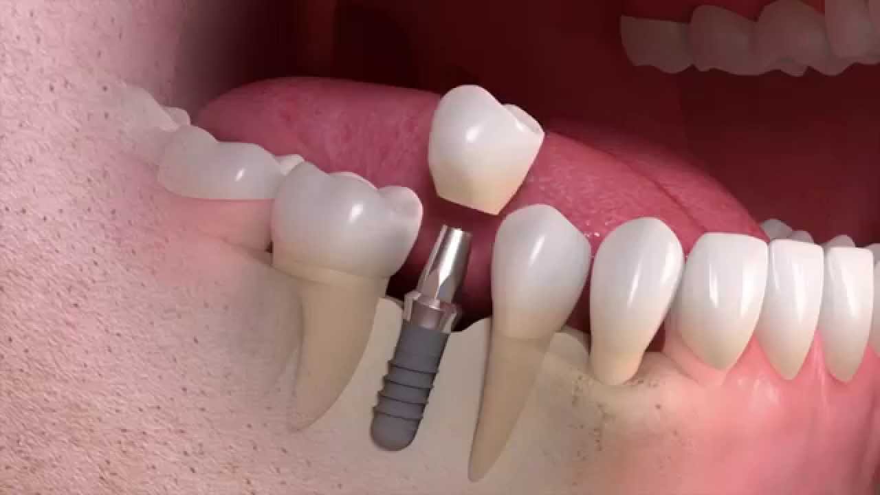 Dental Implants Abroad